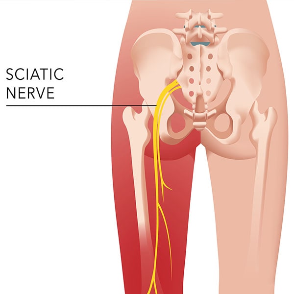 What is Sciatica?