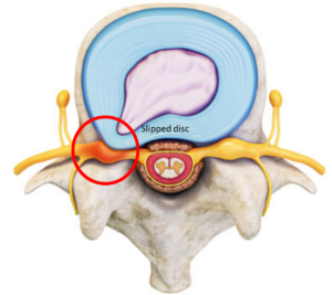 Slipped Disc