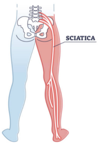 Sciatica Location